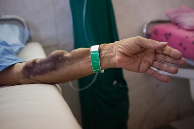 سن بیماران کلیوی در ایران کاهش یافته است